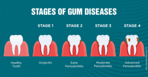 gum disease seattle